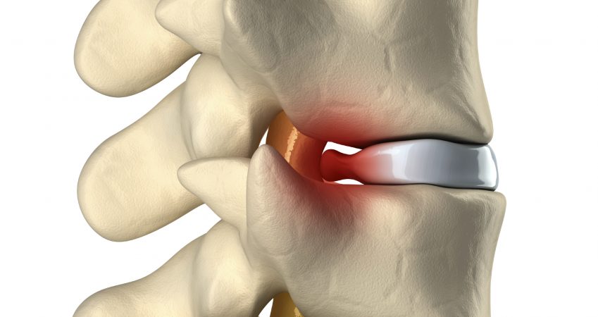 What is the remedy for a disc bulge (which results in lower back pain) other than medication and surgery?