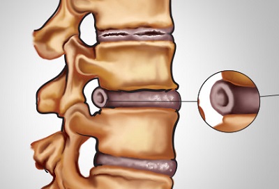 If I have a bulging disc that is pressed against my nerve, and I feel pain in my lower back, is the pain caused by my emotions or by the nerve being pinched?