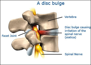 Do you have a treatment for a C3 C4 disc bulge?