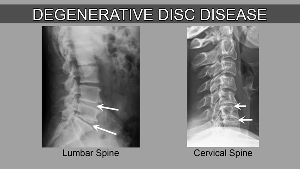 What treatment options are there for Degenerative Disc Disease besides spinal fusion surgery? (I don’t want to just take pain pills, or shots every month, forever).