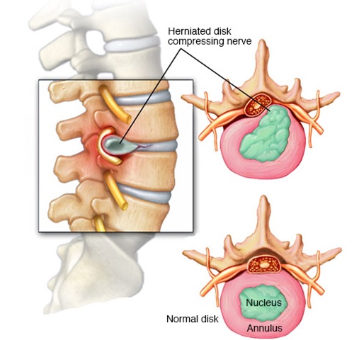 What’s the best way to sleep or sit with a herniated disk?