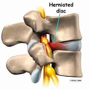 How much pain would I be in with a full blown herniated disk? I hurt my back recently from weightlifting and have sciatica. It is mild and I’ve had it for a few months. I’m thinking this is due to a herniated disk, but I would be in more pain, right?