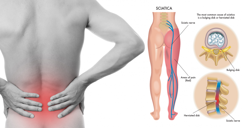 What is the worst case scenario for a 25 year old suffering from sciatica?