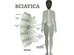 What is the fastest way to get cure from sciatica nerve pain?